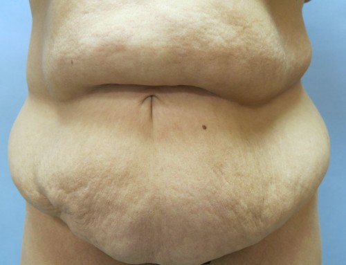 Abdominoplasty Before 2