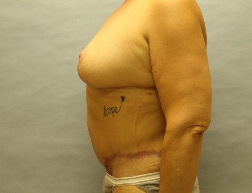 Abdominoplasty After 1