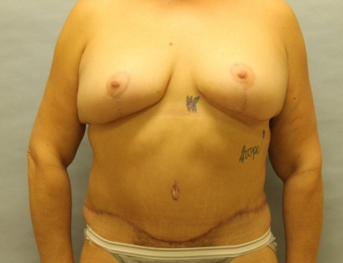 Abdominoplasty After 2