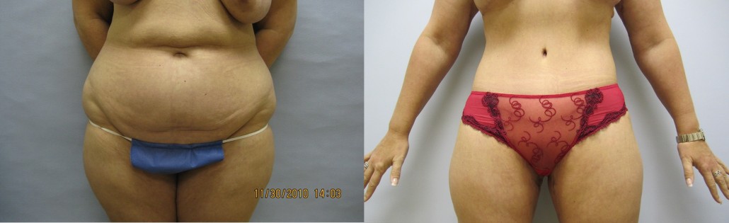 abdominoplasty