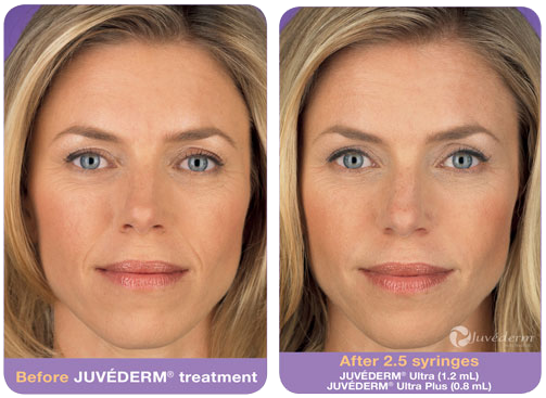 Juvederm in Raleigh 