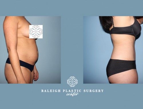 Looking to have a flatter stomach and no stretch marks?  Our surgeons will help you prepare for this summers beach season with our Tummy Tuck procedures. Call us today to book your appointment with us! 919-872-2616 . https://raleighplasticsurgery.com/staging/