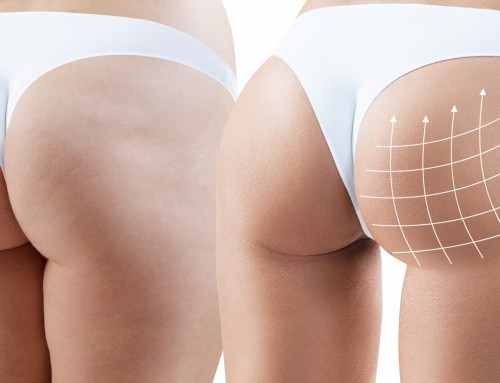 Do you want to use your fat deposits from other areas of your body to enhance the appearance of your buttocks? The brazilian butt lift provides excellent shaping and sculpting capabilities for the physique you want. Call Tina now to schedule an appointment! +1 919-872-2616 https://raleighplasticsurgery.com/staging/