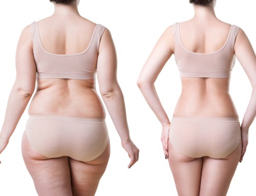 LIPOSUCTION IS AWESOME, BUT HOW FANTASTIC IS IT?