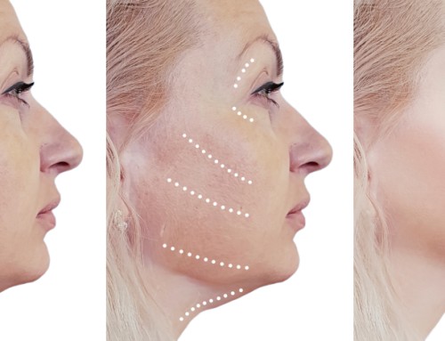 What is a Facelift?