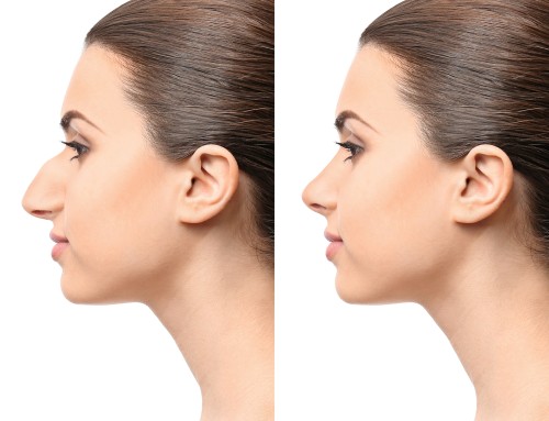 The Advantages of Rhinoplasty