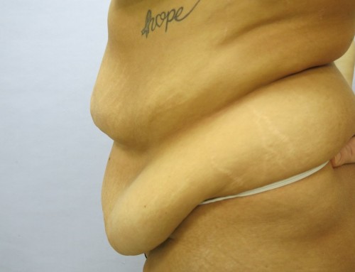 Abdominoplasty Before 1