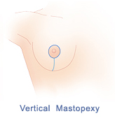 breast-lift-diagram-vertical-mastopexy (1)
