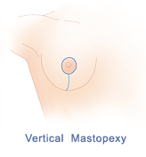 Breast Lift Raleigh, North Carolina - Mastopexy Plastic Surgery NC