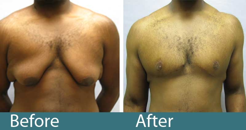 Gynecomastia Surgery - Raleigh Plastic Surgery Center