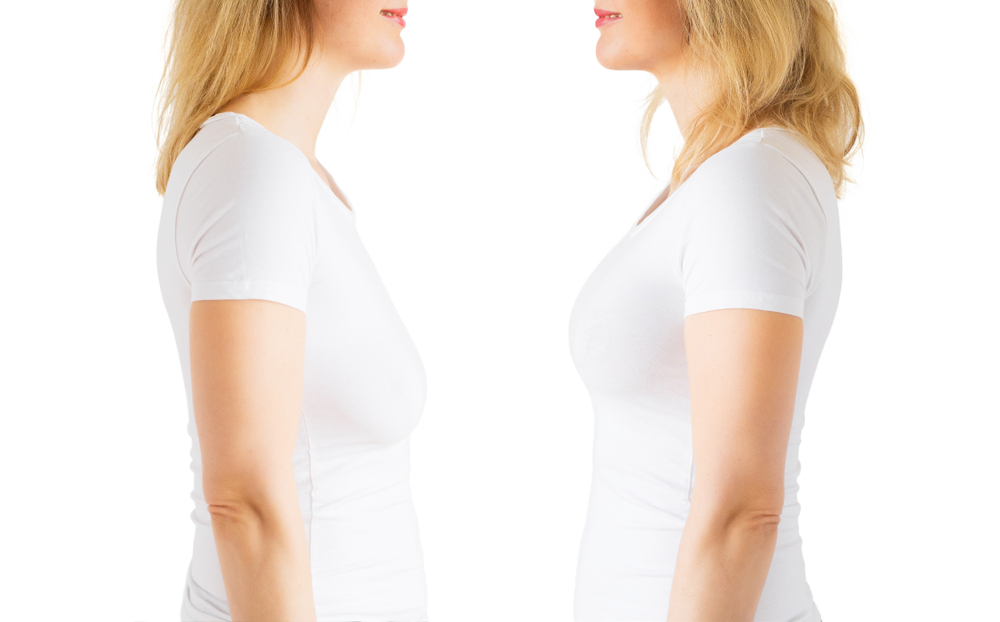 Breast Lifts Explained, Mastoplexy Procedure