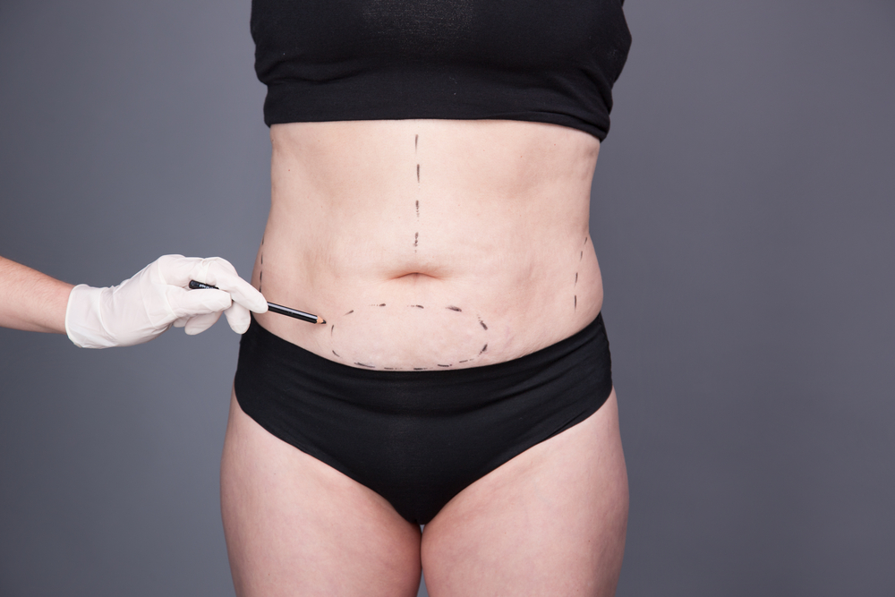 A tummy tuck tightens the abdominal wall and flattens the stomach. The  abdomen's loose, extra fat and skin are removed by the surgeon. After  pregnancy, some women choose for a tummy tuck.