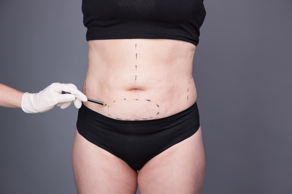 Apronectomy To Remove Loose Tummy Skin