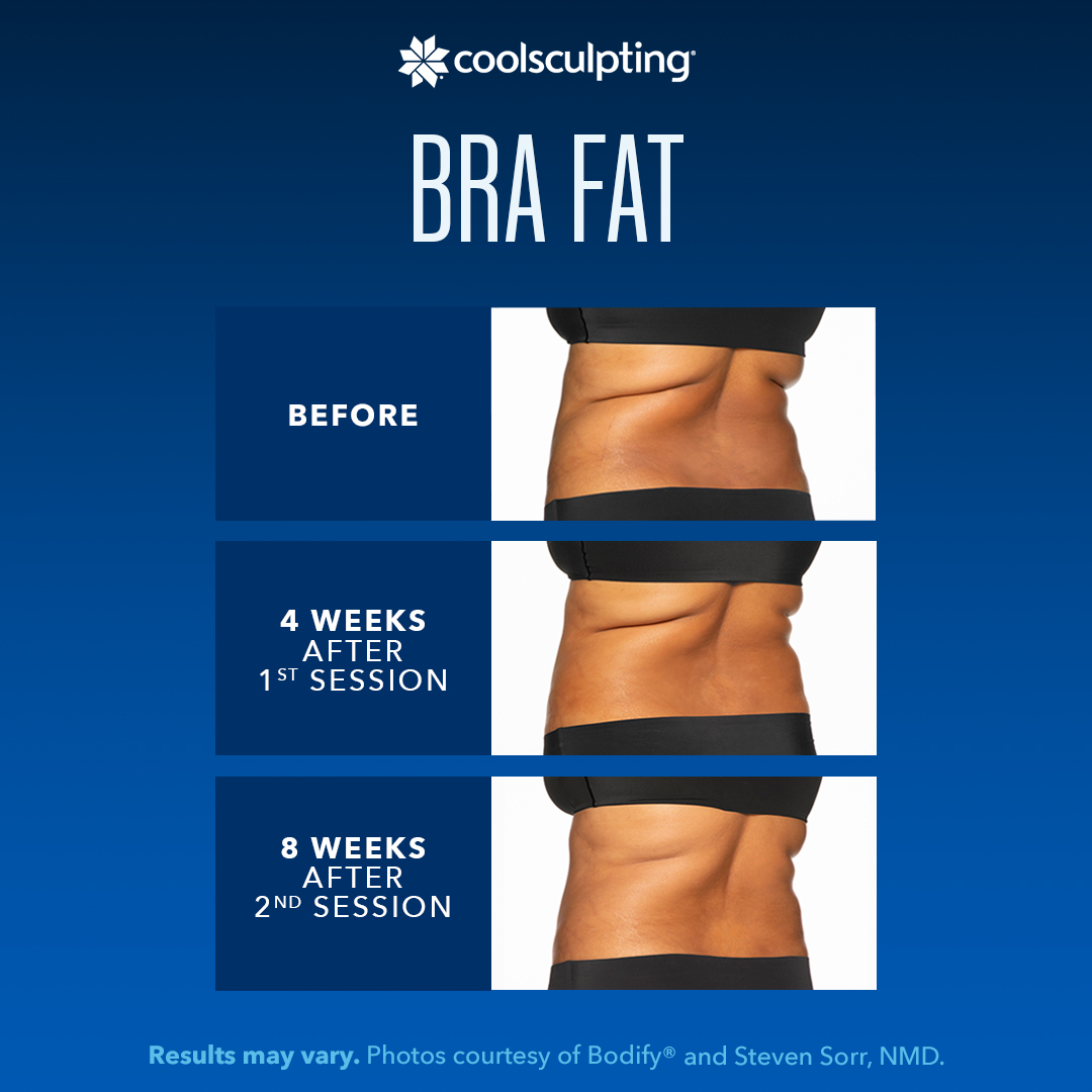 CoolSculpting® consultations are now available at Raleigh Plastic