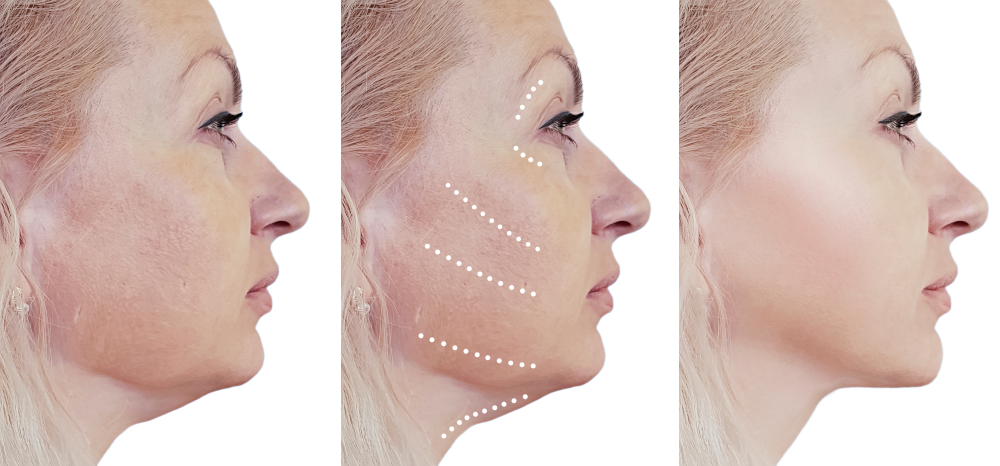 What Is A Facelift Raleigh Plastic Surgery Center