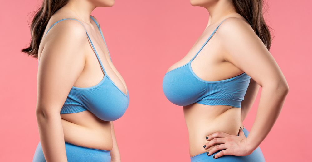 Breast Surgery Archives - Raleigh Plastic Surgery Center
