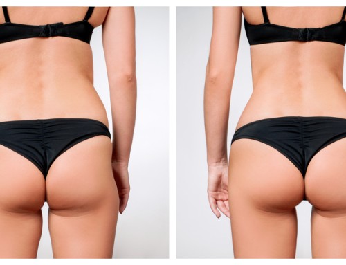 The Process of Getting Liposuction
