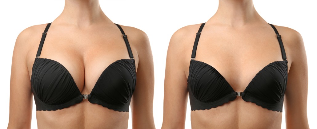 Breast Reduction