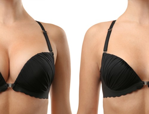 I currently have implants and I want smaller breasts. What are my options?