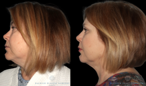 Patient A left eyes (2)