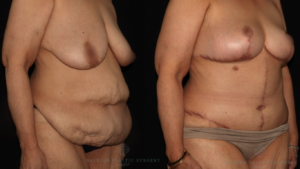 Patient A rt quarter