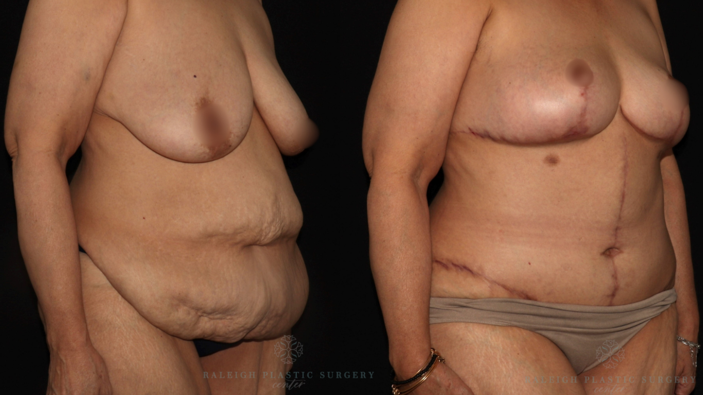 Patient A rt quarter