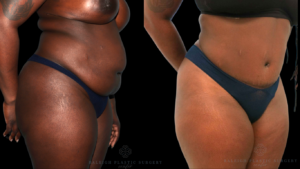 Patient B Rt quarter