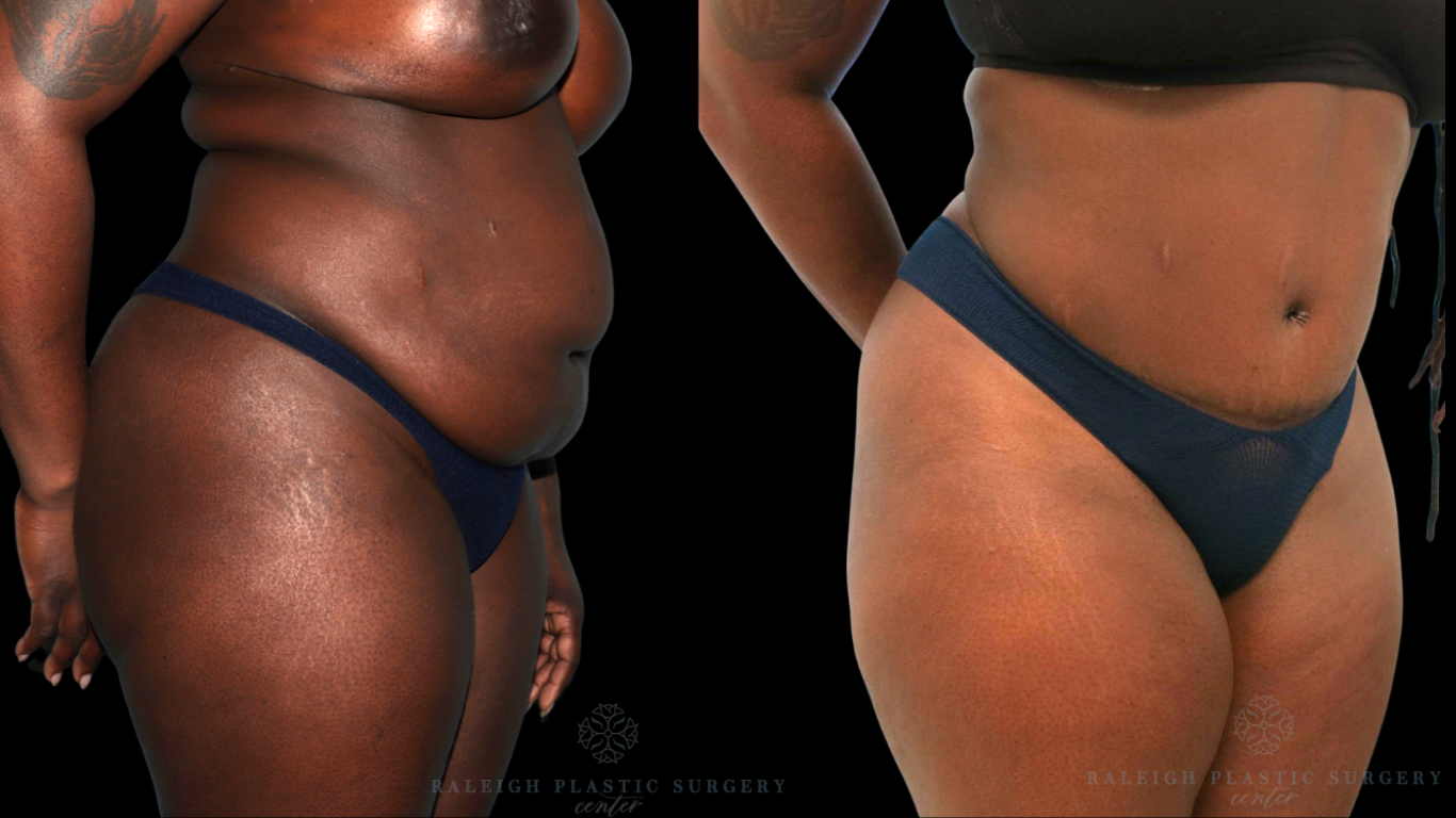 Patient B Rt quarter