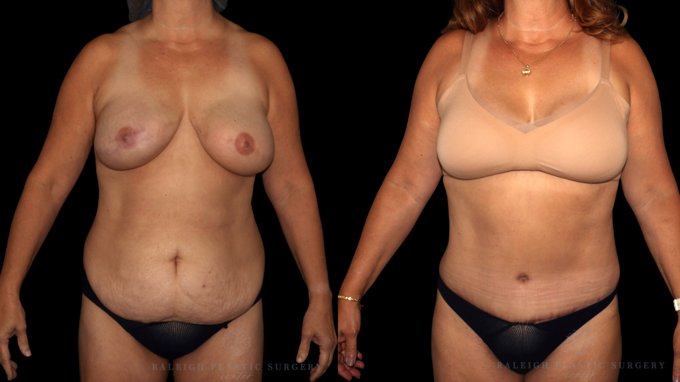 Patient D front logo