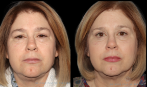 patient A eyes front