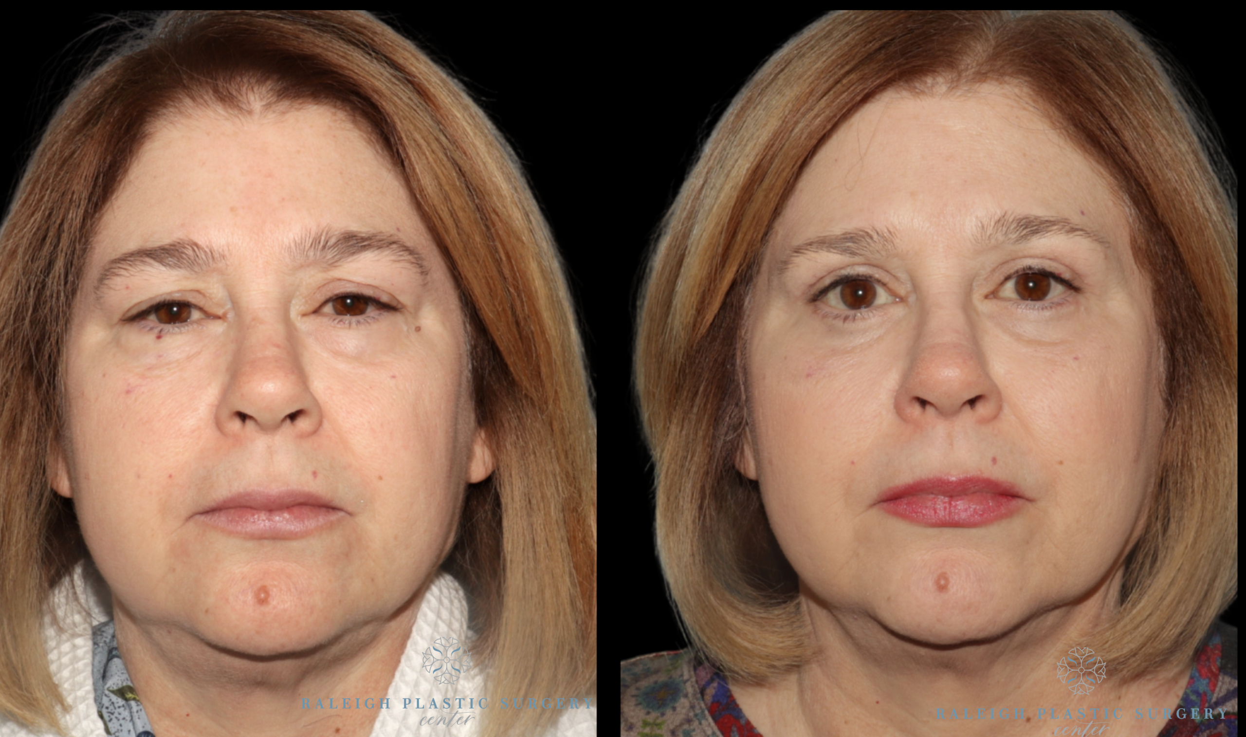 patient A eyes front