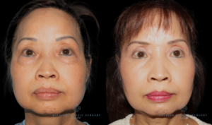 patient C front eyes