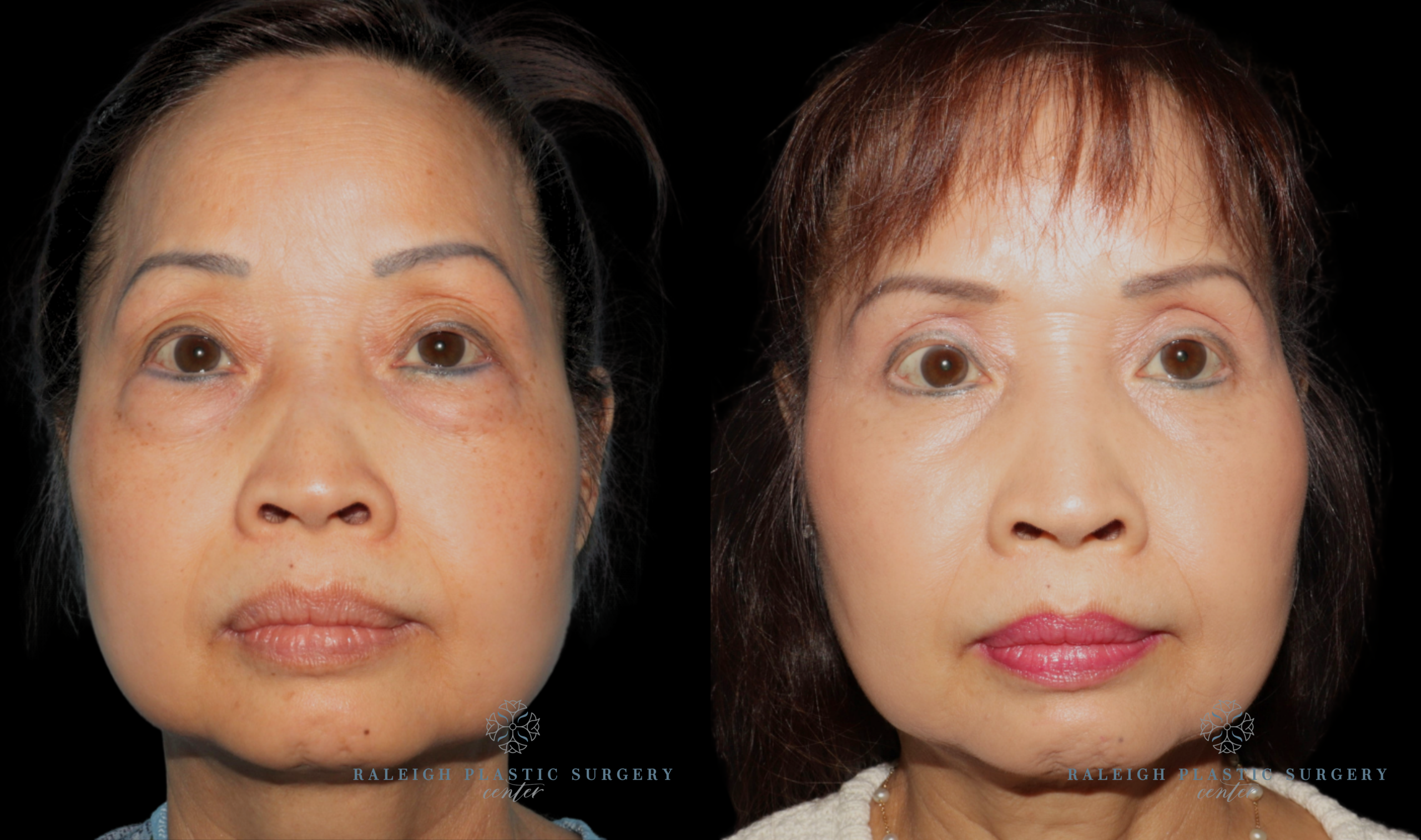 patient C front eyes